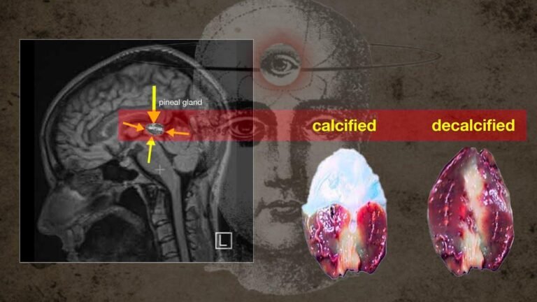 I finally removed the calcification from my pineal gland! Let me tell you how I did it.